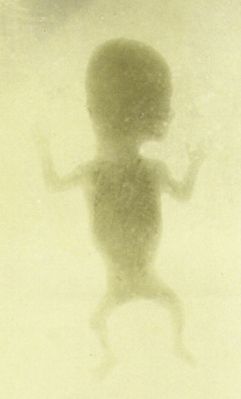 Snímka dieťaťa, kedy sa MUDr. Vojtech Alexander snažil skúmať vývoj ľudského plodu.